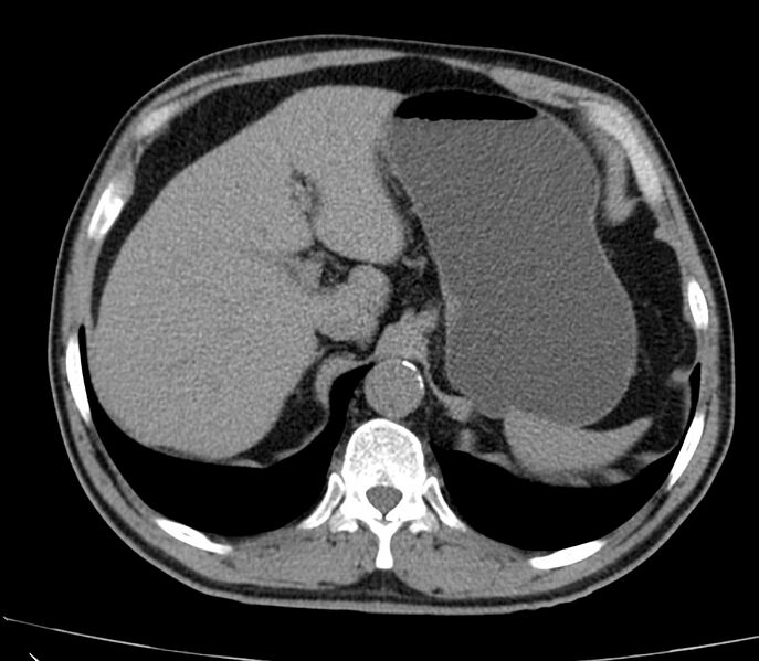 File:Abdominal aortic aneurysm (Radiopaedia 22421-22458 non-contrast 10).jpg