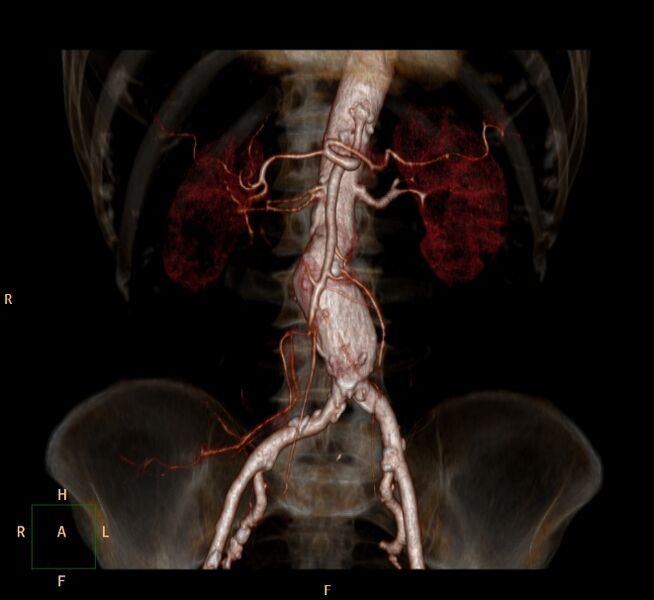 File:Abdominal aortic aneurysm (Radiopaedia 23703-23856 3D 1).jpg