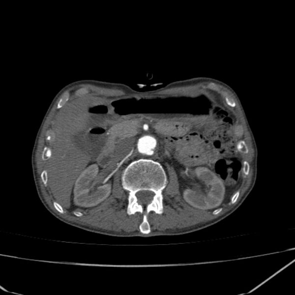 File:Abdominal aortic aneurysm (Radiopaedia 23703-23856 Axial C+ arterial phase 25).jpg