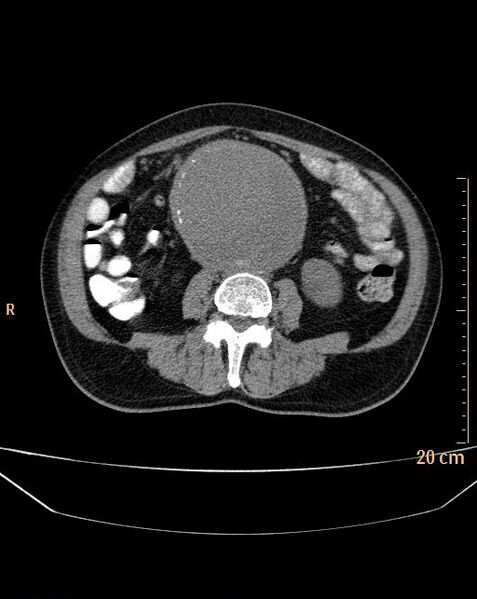 File:Abdominal aortic aneurysm (Radiopaedia 25985-26121 Axial non-contrast 15).jpg