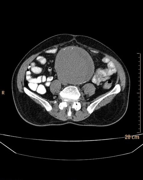 File:Abdominal aortic aneurysm (Radiopaedia 25985-26121 Axial non-contrast 18).jpg