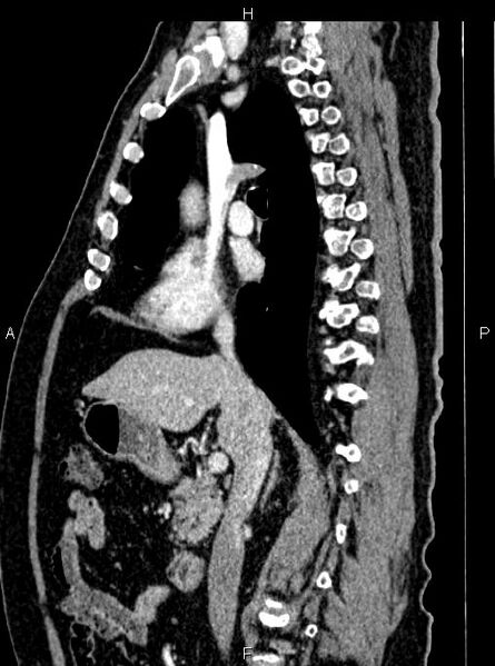 File:Abdominal aortic aneurysm (Radiopaedia 83094-97462 Sagittal renal cortical phase 55).jpg