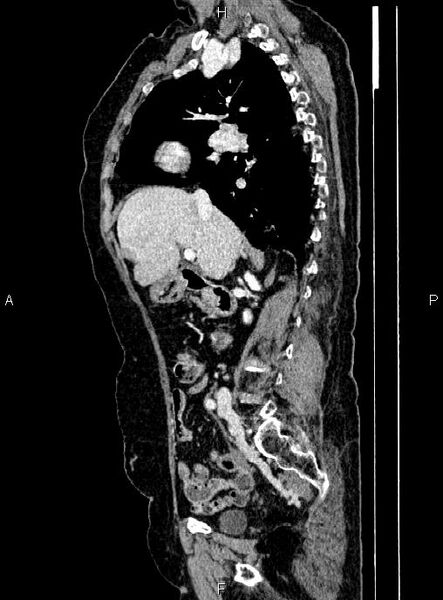 File:Abdominal aortic aneurysm (Radiopaedia 85063-100606 Sagittal C+ arterial phase 30).jpg