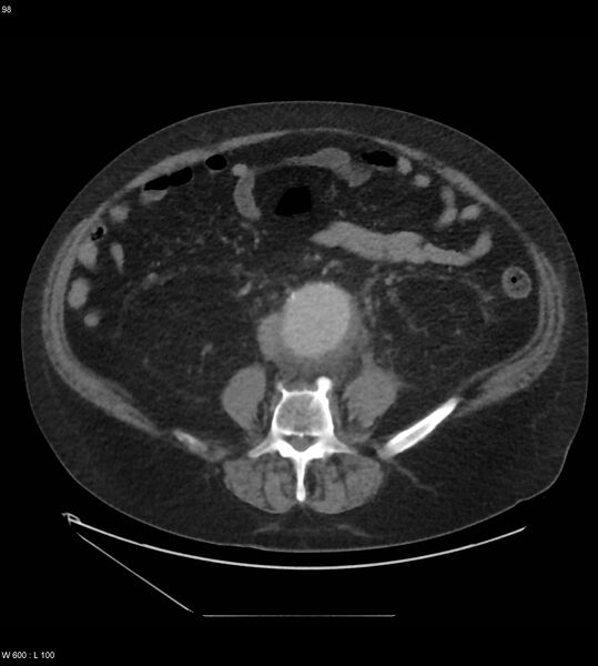 File:Abdominal aortic aneurysm with intramural hematoma then rupture (Radiopaedia 50278-55631 Axial C+ arterial phase 89).jpg