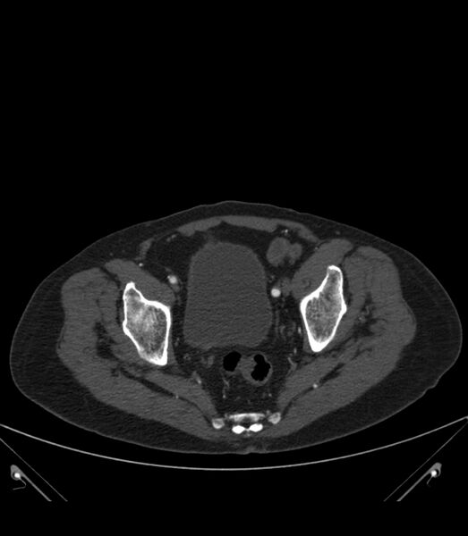 File:Abdominal aortic aneurysm with thrombus fissuration (Radiopaedia 46218-50618 Axial C+ arterial phase 39).jpg