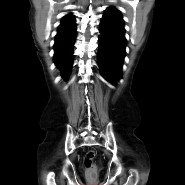 File:Abdominal aortic interposition tube graft and aneurysm thrombosis (Radiopaedia 71438-81857 Coronal C+ arterial phase 24).jpg