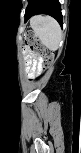 File:Abdominal wall and retroperitoneal tuberculosis (Radiopaedia 88137-104729 Sagittal C+ portal venous phase 24).jpg
