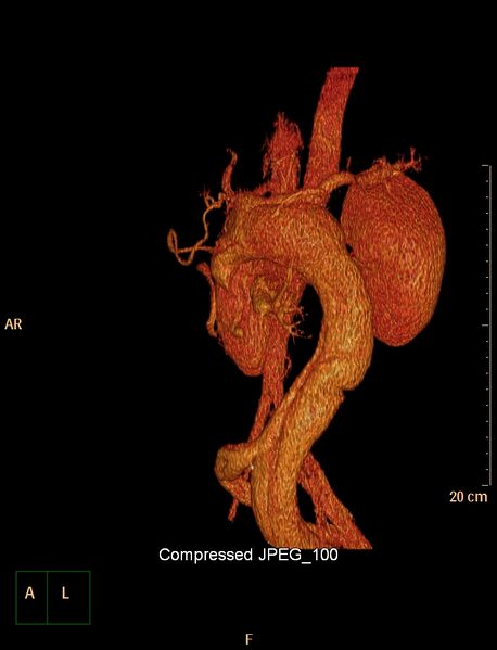 File:Abernethy malformation (Radiopaedia 42006-45036 3D reconstruction C+ portal venous phase 2).jpg