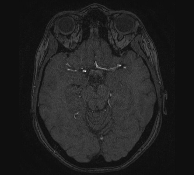 File:Accessory middle cerebral artery and ICA aneurysm (Radiopaedia 22656-22674 MRA 49).jpg
