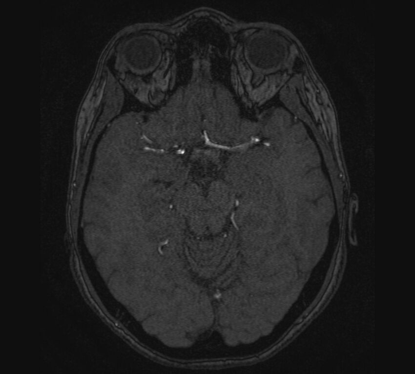 Accessory middle cerebral artery and ICA aneurysm (Radiopaedia 22656-22674 MRA 49).jpg