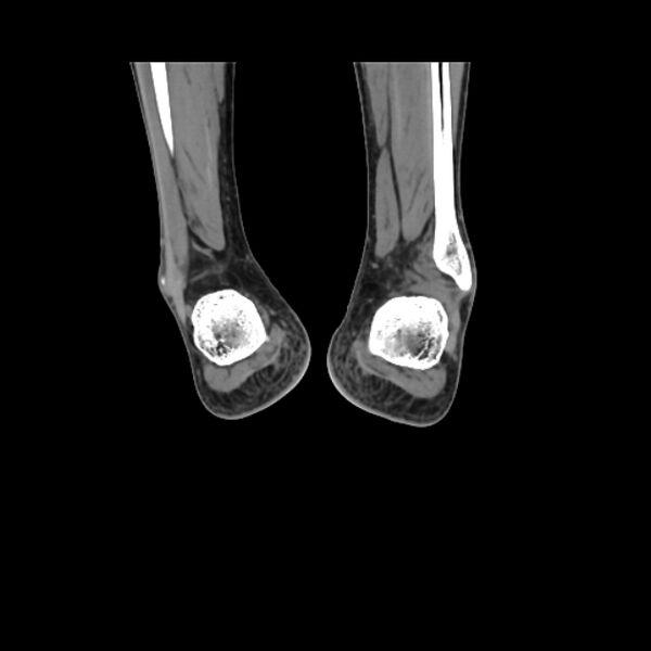 File:Accessory soleus muscle (Radiopaedia 61069-68943 Coronal non-contrast 58).jpg