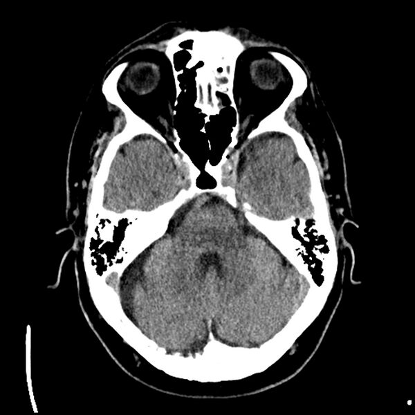 File:Acute A3 occlusion with ACA ischemic penumbra (CT perfusion) (Radiopaedia 72036-82525 Axial non-contrast 12).jpg