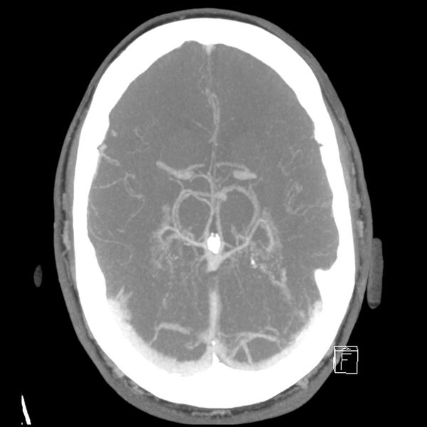File:Acute A3 occlusion with ACA ischemic penumbra (CT perfusion) (Radiopaedia 72036-82527 Axial 10 sec delay thick MIP 9).jpg