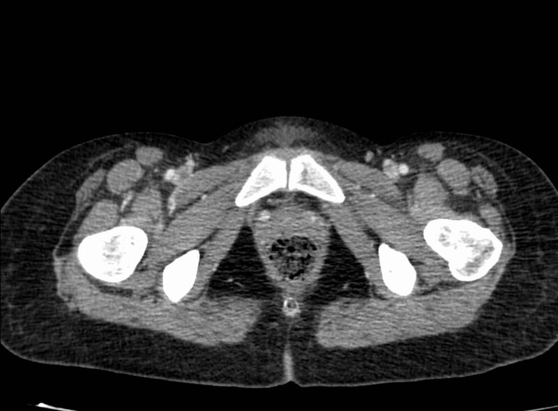 File:Acute Budd-Chiari syndrome (Radiopaedia 60858-68638 Axial C+ portal venous phase 303).jpg