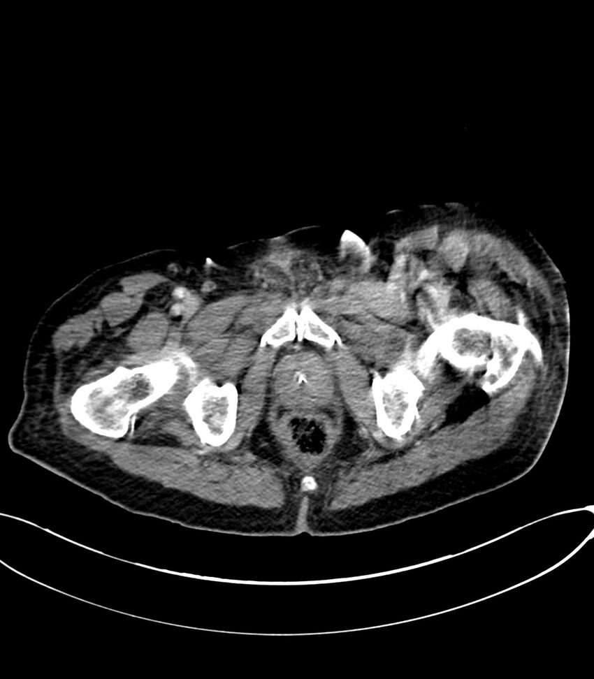 Acute arterial mesenteric ischemia (Radiopaedia 78238-90828 Axial C+ portal venous phase 144).jpg