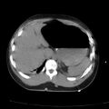 Acute aspiration pneumonitis (Radiopaedia 33605-34703 Axial non-contrast 79).jpg
