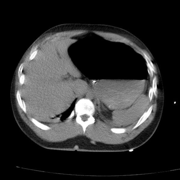 File:Acute aspiration pneumonitis (Radiopaedia 33605-34703 Axial non-contrast 79).jpg