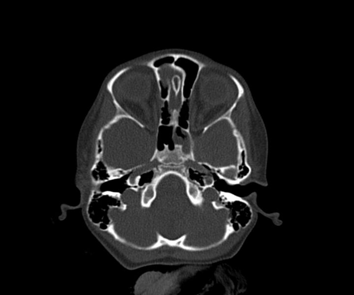 File:Acute epidural hematoma (Radiopaedia 63659-72335 Axial bone window 4).jpg