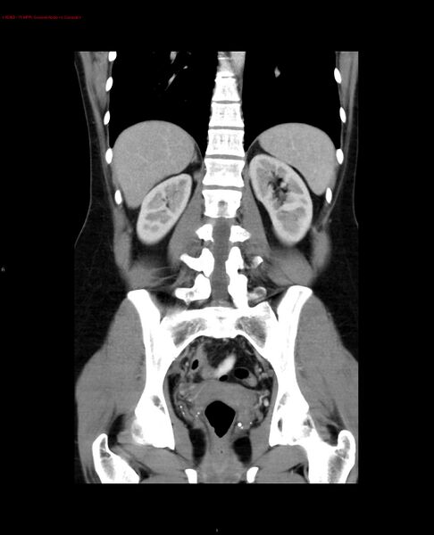 File:Acute gastritis (Radiopaedia 21043-20975 Coronal C+ portal venous phase 5).jpg