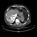 Acute heart failure (CT) (Radiopaedia 79835-93075 Axial C+ arterial phase 64).jpg