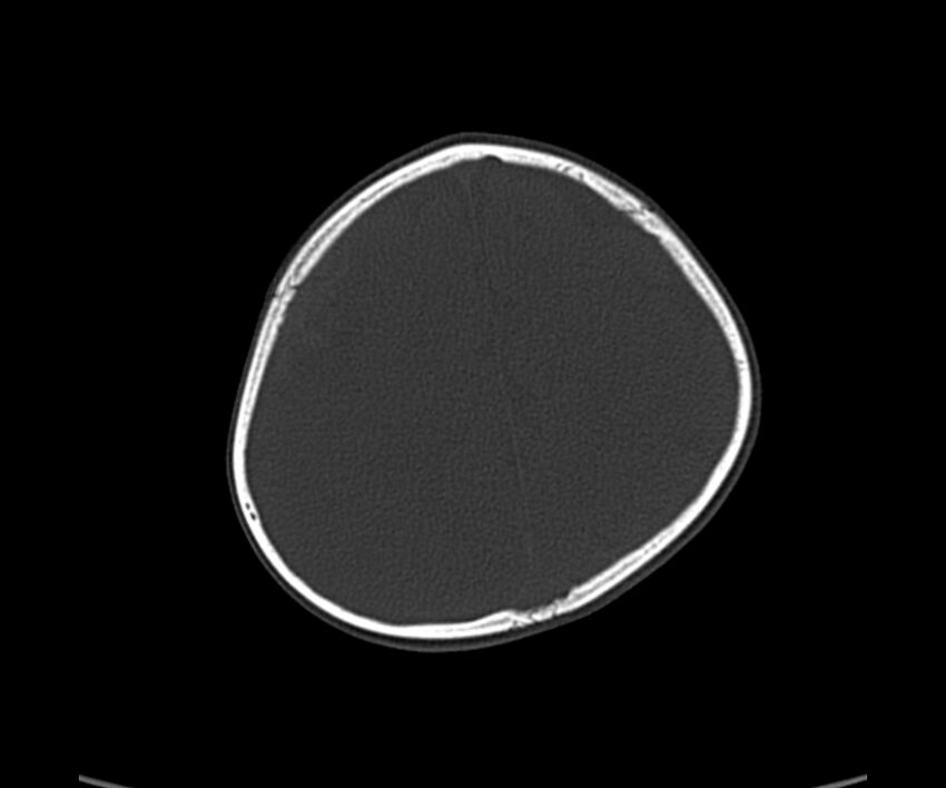 Acute hemorrhagic contusion (Radiopaedia 63660-72336 Axial bone window 53).jpg