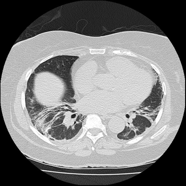 File:Acute interstitial pneumonitis (Radiopaedia 45404-49452 Axial lung window 56).jpg