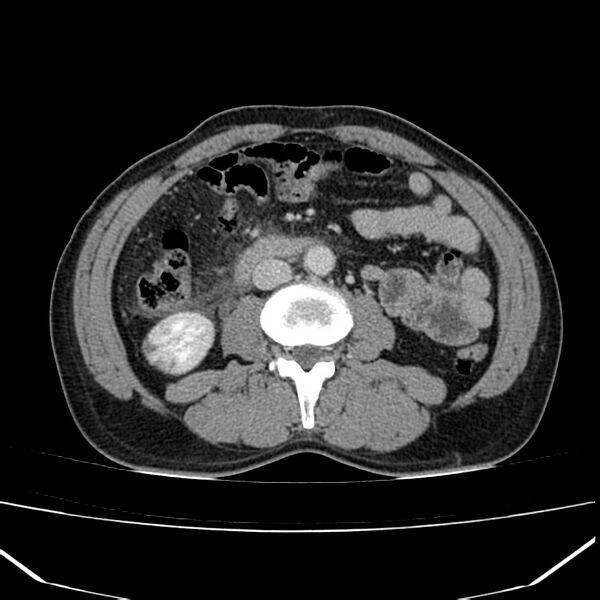 File:Acute pancreatitis (Radiopaedia 22572-22596 Axial C+ portal venous phase 38).jpg