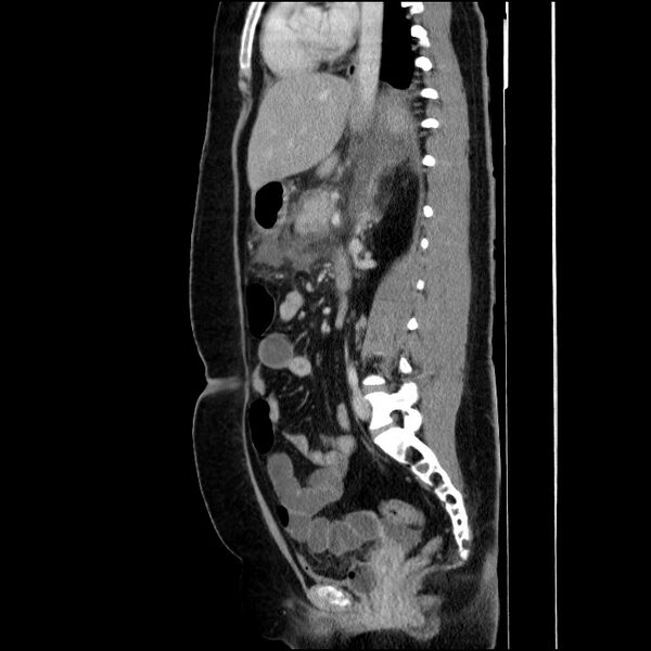 File:Acute pancreatitis (Radiopaedia 69236-79012 Sagittal C+ portal venous phase 48).jpg