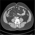 Acute pancreatitis - mild (Radiopaedia 27796-28033 C+ portal venous phase 37).jpg