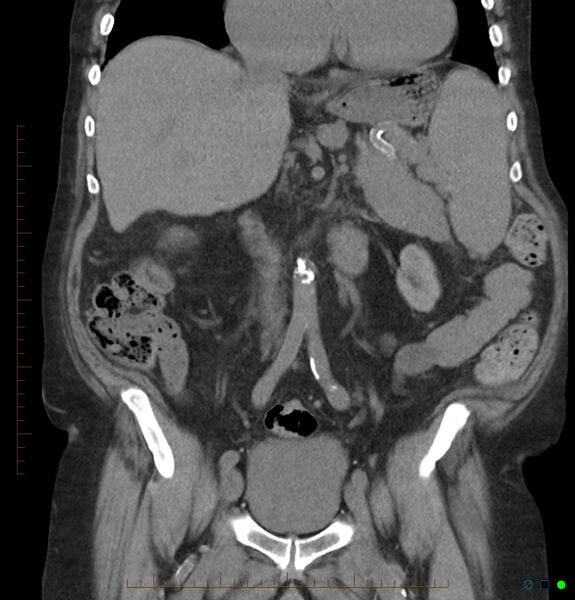 File:Acute renal failure post IV contrast injection- CT findings (Radiopaedia 47815-52557 Coronal non-contrast 21).jpg