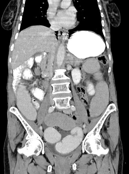 File:Acute small bowel (ileal) volvulus (Radiopaedia 71740-82139 Coronal C+ portal venous phase 59).jpg