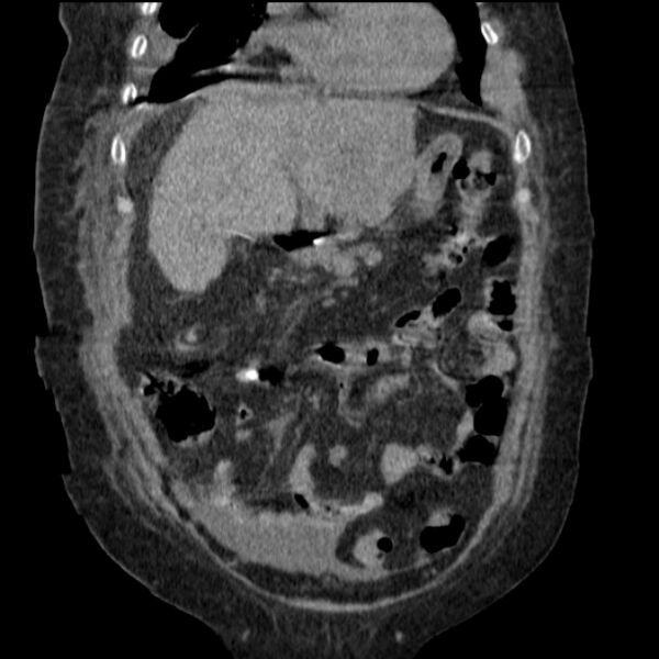 File:Acute tubular necrosis (Radiopaedia 28077-28334 G 29).jpg