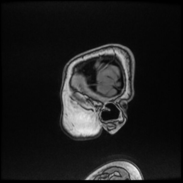 File:Adamantinomatous craniopharyngioma (Radiopaedia 77407-89529 Sagittal T1 C+ 8).jpg