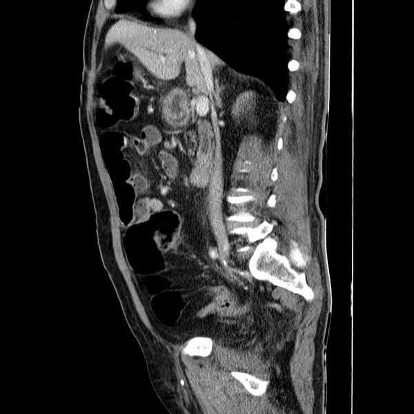 File:Adenocarcinoma of colon with entero-colic fistula (Radiopaedia 22832-22852 Sagittal C+ portal venous phase 27).jpg
