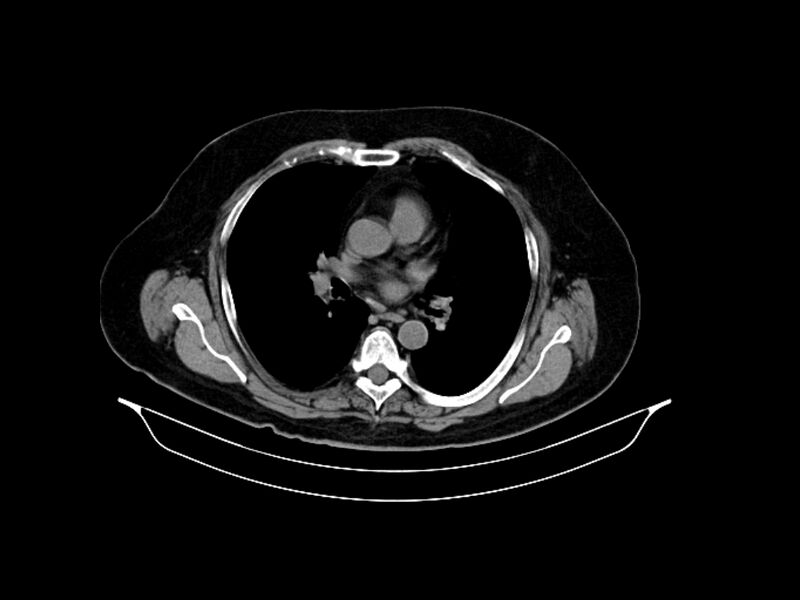 File:Adenocarcinoma of pancreas with hepatic metastasis (Radiopaedia 64332-73122 Axial non-contrast 4).jpg