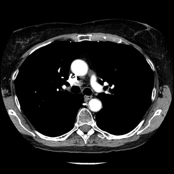 File:Adenocarcinoma of the lung (Radiopaedia 41015-43755 Axial C+ portal venous phase 46).jpg