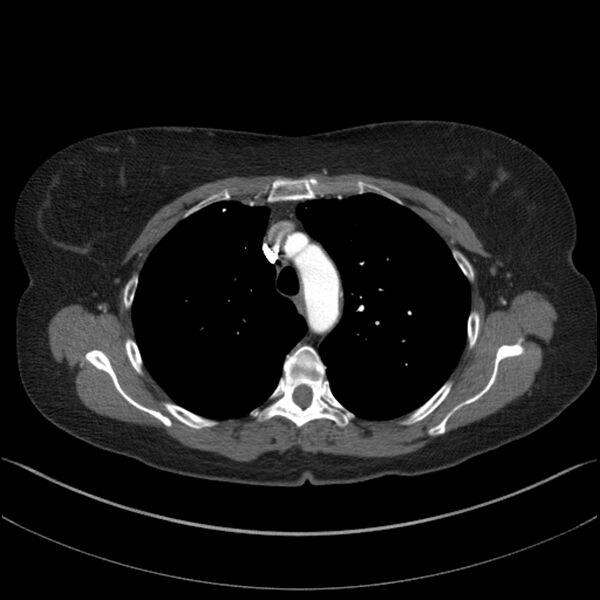 File:Adenocarcinoma of the lung (Radiopaedia 44205-47803 Axial C+ portal venous phase 24).jpg