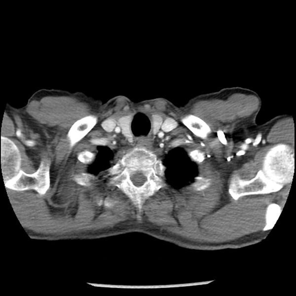 File:Adenocarcinoma of the lung - micropapillary predominant (Radiopaedia 42446-45563 Axial C+ portal venous phase 4).jpg