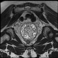 Adenoma malignum of the cervix (Radiopaedia 24460-24765 Coronal T2 20).jpg