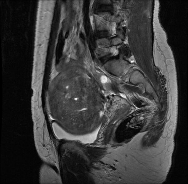 File:Adenomyosis on MRI (Radiopaedia 29328-29780 Sagittal T2 5).jpg