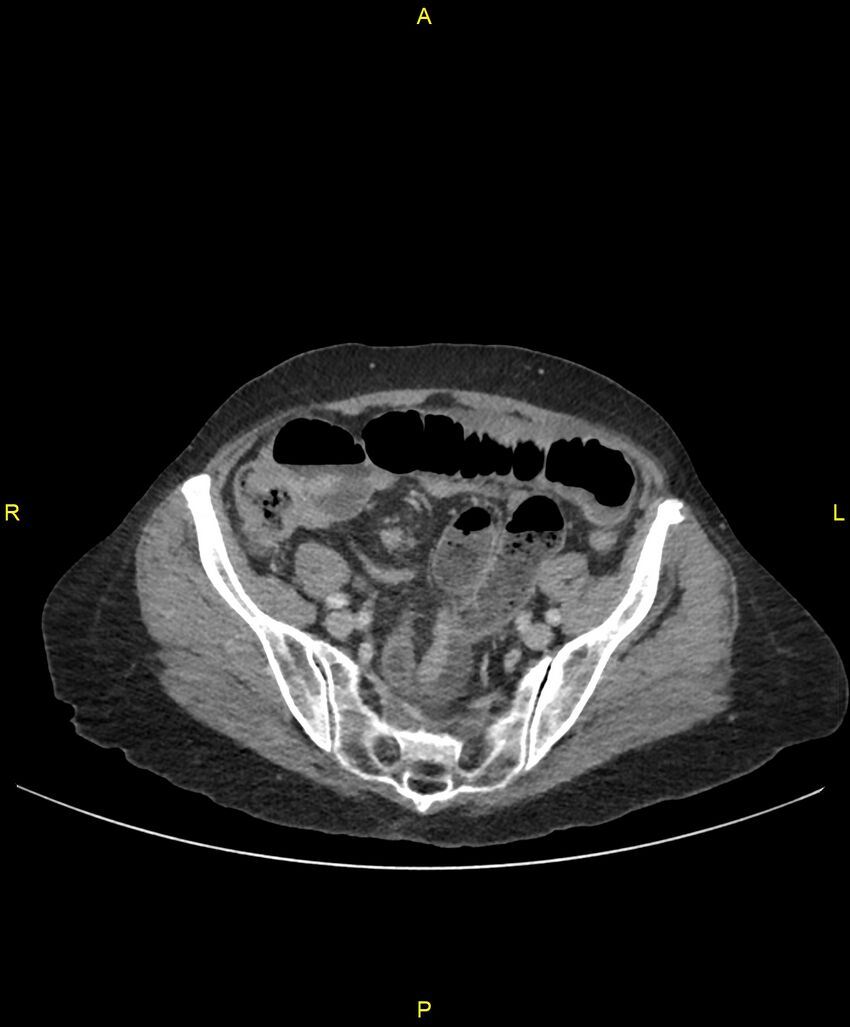 Adhesional small bowel obstruction (Radiopaedia 85402-101024 Axial C+ portal venous phase 217).jpg