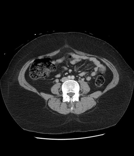 File:Adrenal cortical carcinoma with IVC invasion and thrombosis (Radiopaedia 34307-35597 Axial C+ portal venous phase 53).jpg