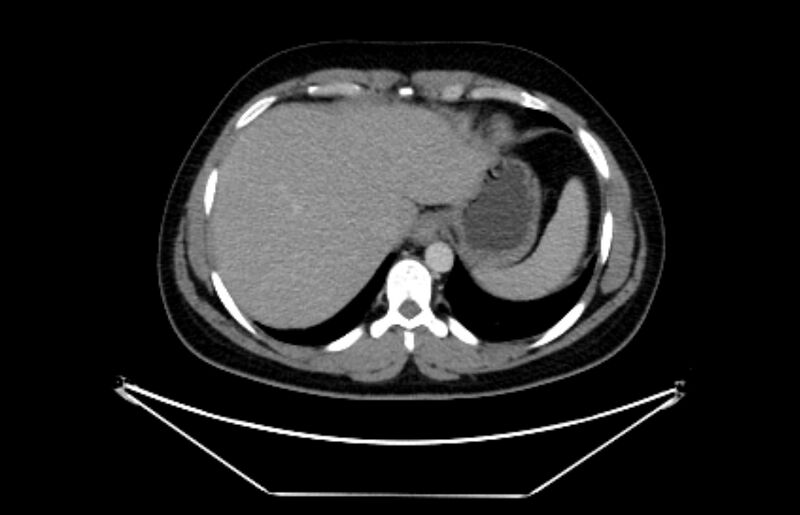 File:Adrenocortical carcinoma (Radiopaedia 80134-93438 Axial C+ portal venous phase 23).jpg