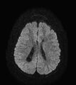 Aicardi syndrome (Radiopaedia 66029-75205 Axial DWI 15).jpg