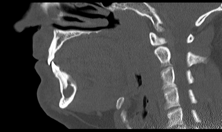 Ameloblastoma (Radiopaedia 33677-34806 Sagittal bone window 30).png