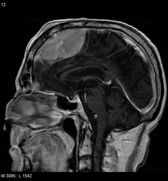 File:Anaplastic meningioma (Radiopaedia 5553-7290 G 1).jpg