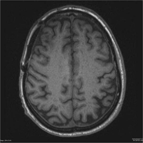 File:Anaplastic meningioma with recurrence (Radiopaedia 34452-35788 Axial T1 102).jpg