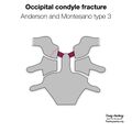 Anderson and Montesano classification of occipital condyle fractures (diagrams) (Radiopaedia 87203-103478 types 3).jpeg