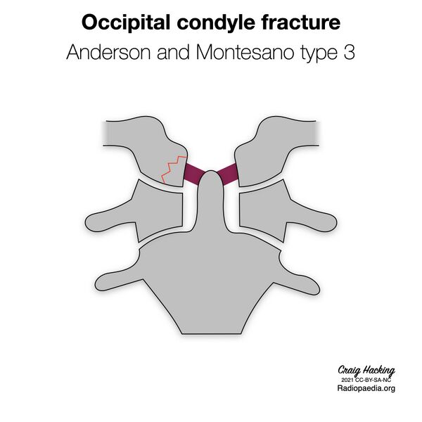 File:Anderson and Montesano classification of occipital condyle fractures (diagrams) (Radiopaedia 87203-103478 types 3).jpeg