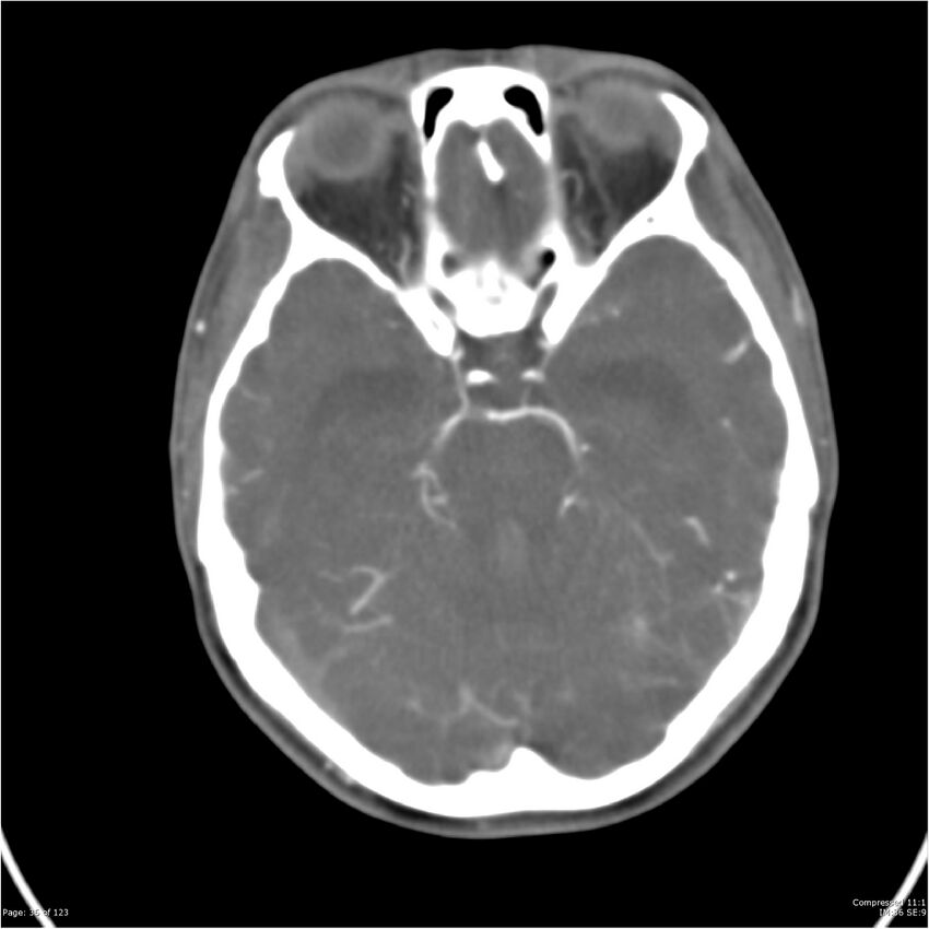 Aneurysmal subarachnoid hemorrhage and Moya Moya disease (Radiopaedia 34306-35593 Axial CT COW 36).jpg